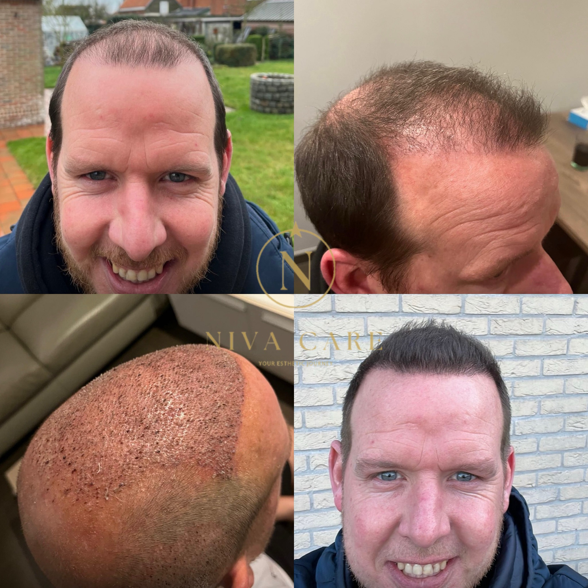 Resultaat haartransplantatie — klant