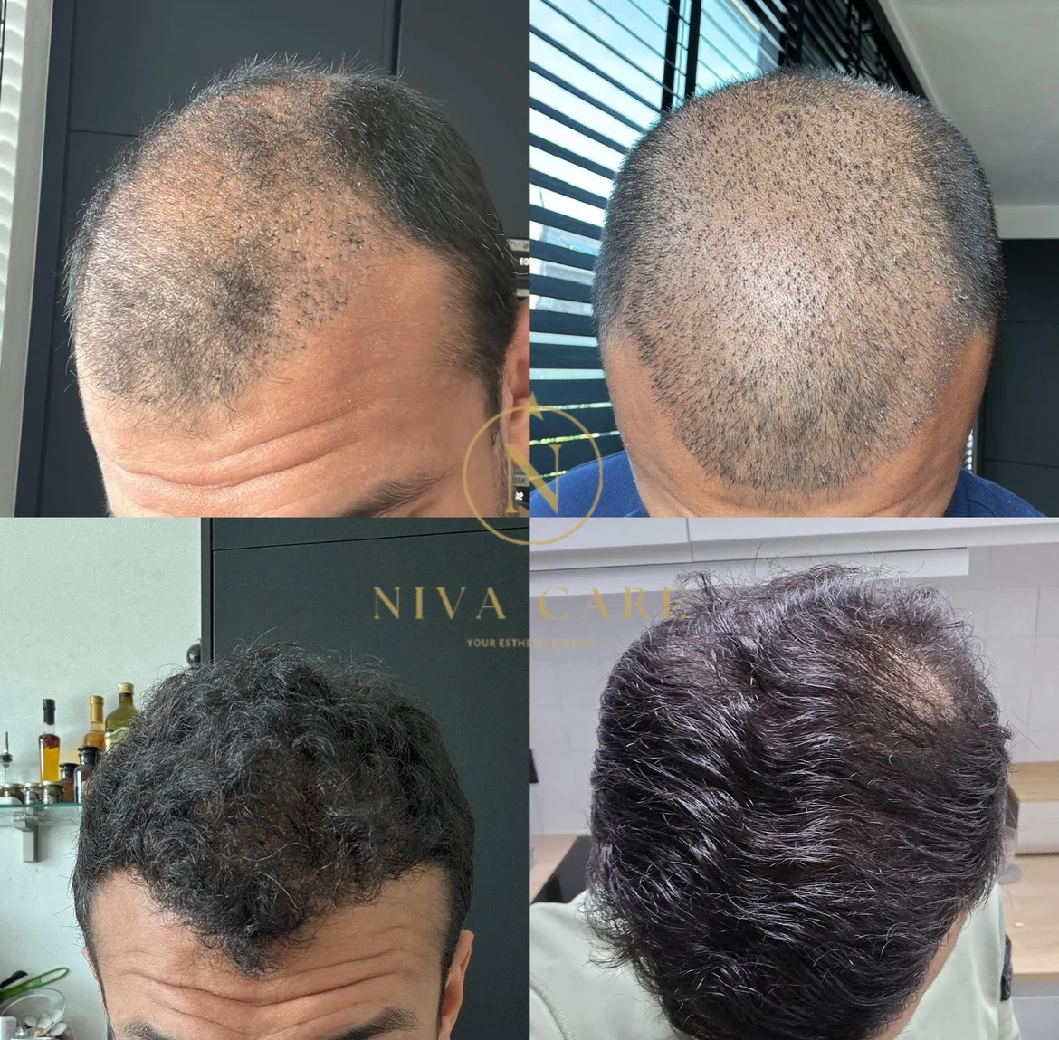 Resultaat haartransplantatie — klant