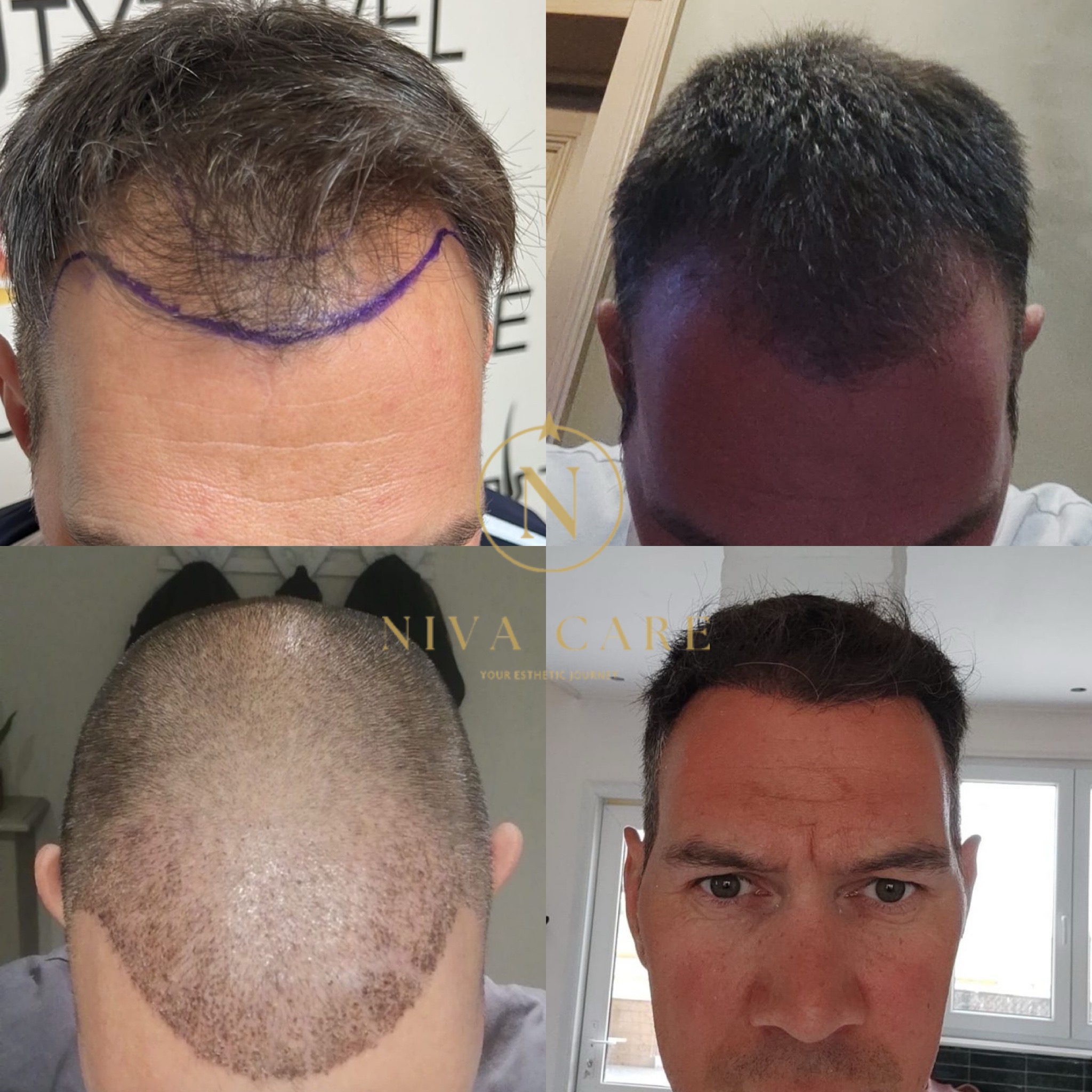 Nico — voor en na haartransplantatie