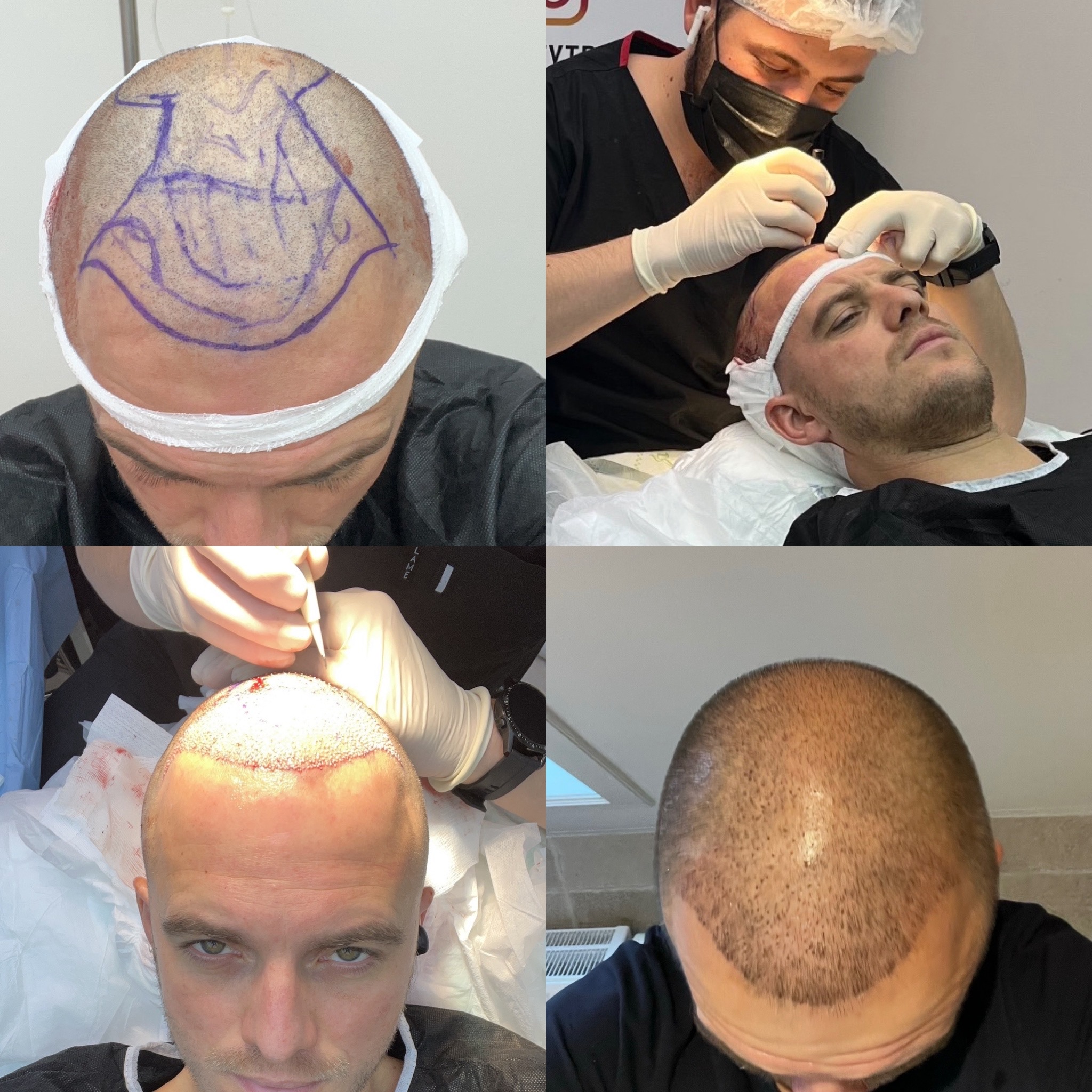 FUE procedure collage